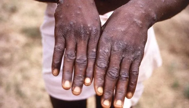 Ilustrasi Cacar Monyet-CNN